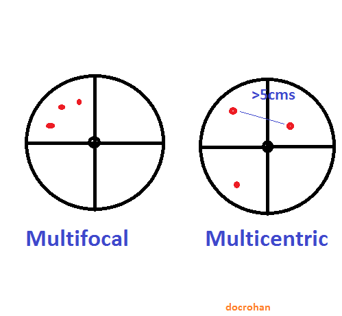 multifocal vs multicentric